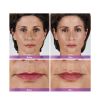 JUVÉDERM VOLBELLA® XC Before and After Two