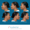 Kybella Before and After 1