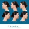 Kybella Before and After 2
