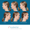 Kybella Before and After 3
