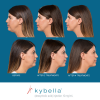 Kybella Before and After 4