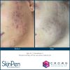 SkinPen® Microneedling