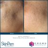 SkinPen® Microneedling