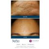 SkinPen® Microneedling