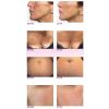 PRX-T33 Before and After