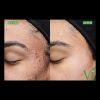 VI Peel Precision Plus B&A