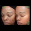 VI Peel Before and After