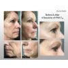 PRX-T33 Before and After