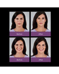 JUVÉDERM VOLLURE™ XC  Before and After