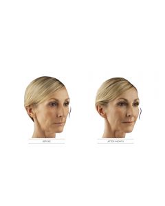 Juvederm Voluma XC B&A
