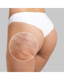 Avéli™ Cellulite Treatment