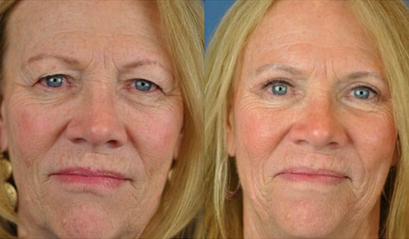 Blepharoplasty