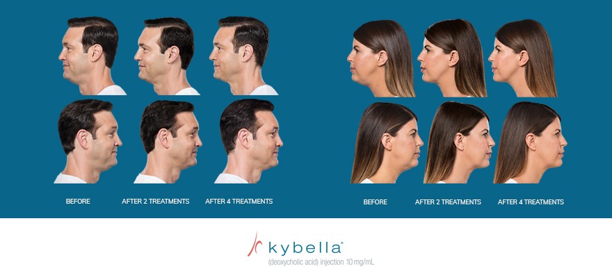 Kybella
