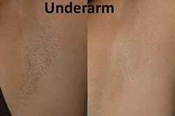laser hair removal before and after