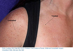 photorejuvenation before and after