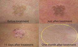 photorejuvenation before and after