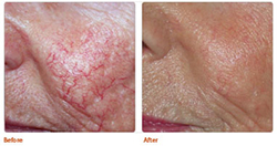 photorejuvenation before and after