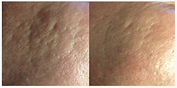 microneedling