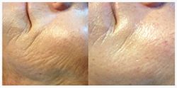 microneedling